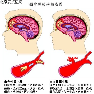 脑血管病