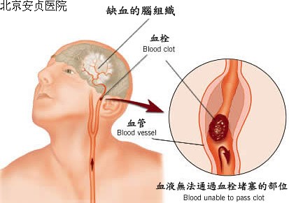 脑血管病 医疗质量万里行 首都医科大学附属北京安贞医院